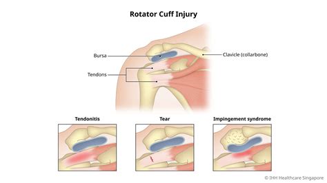 Rotator Cuff Shoulder Pain And Injuries Rotator Cuff Injury