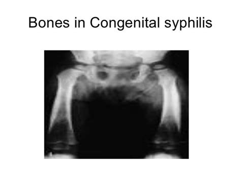 Syphilis And Neurosyphilis 101