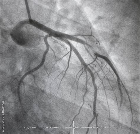 Coronary Angiogram Medical X Ray For Heart Disease Coronary Artery