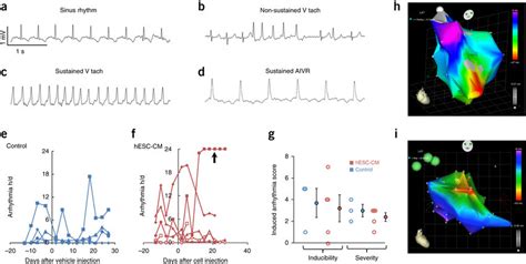 Analysis Of Arrhythmias Ad Electrocardiograms From Telemetry