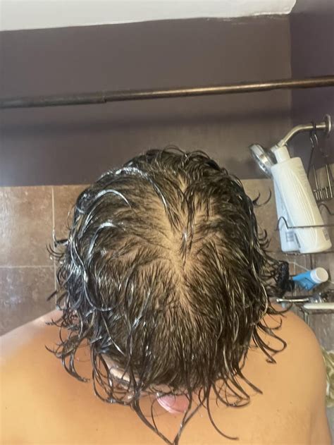 Hair When Wet Diffuse Thinning Rmalehairadvice