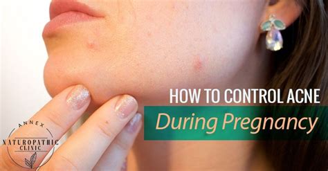 How To Control Acne During Pregnancy Naturopathy For Modern Living