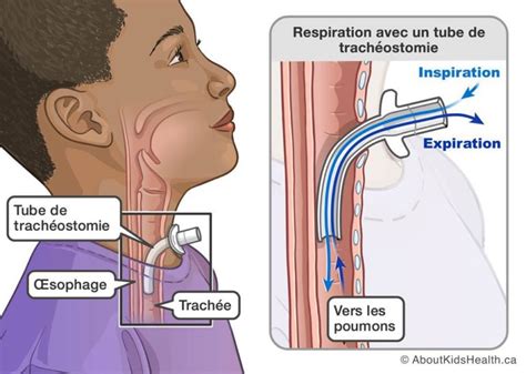 La Trach Otomie P Diatrique Association Fil D Air