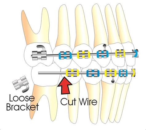 My Wire Came Loose And Is Poking What Do I Do Ask An Orthodontist