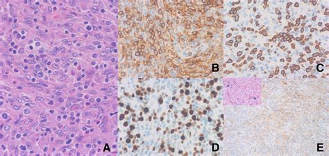 Epstein Barr Virus Positive Mucocutaneous Ulcer Plasmablastic Type