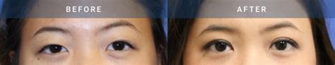 Asian Eyelid Surgery Case Radiance Surgery Aesthetic Medicine