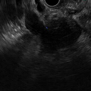 Endoscopic ultrasonogram shows an ill-defined hypoechoic mass in the... | Download Scientific ...