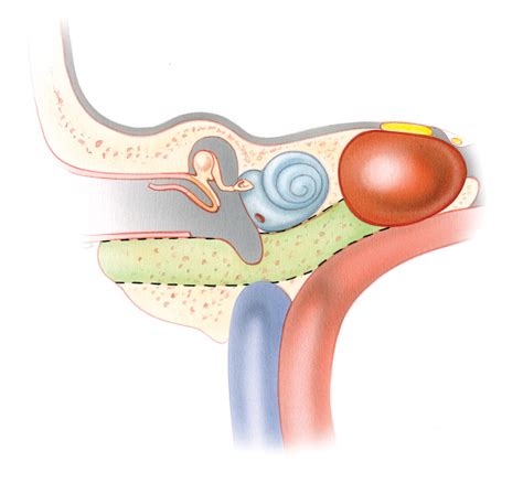 Petrous Apicotomy: Infracochlear and Infralabyrinthine Approaches ...