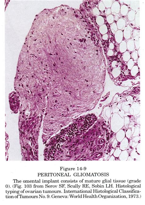 Pathology Outlines Teratoma Immature