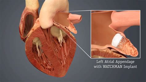 Hca Virginia Watchman Video 2 Left Atrial Appendage Closure Device