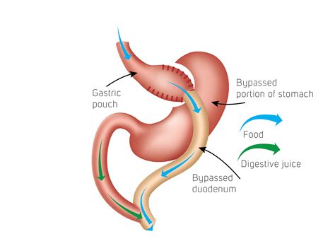 Gastric Bypass Surgery Procedure Cost In Uk