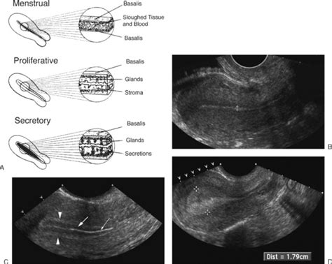 ULTRASOUND EVALUATION OF THE UTERUS | Radiology Key | Ultrasound ...