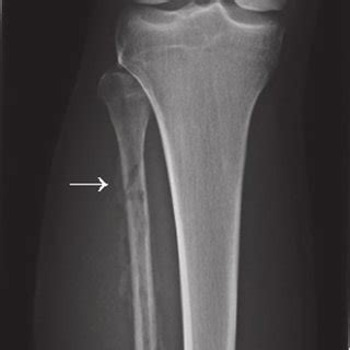 X-ray of the fibula of our patient at initial presentation without ...