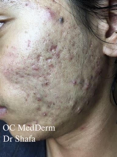 Fractional Co2 Laser Resurfacing For Acne Scar Correction