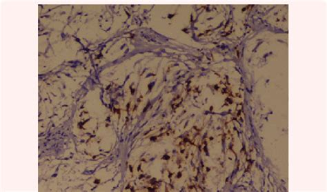 On Immunohistochemistry The Foci Of Nerve Proliferation Showed Diffuse