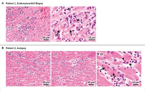 Myocarditis After Covid Mrna Vaccination Nejm