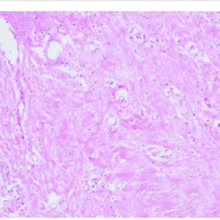 Histological View Hematoxylin And Eosin Stain X200 Of The Cyst