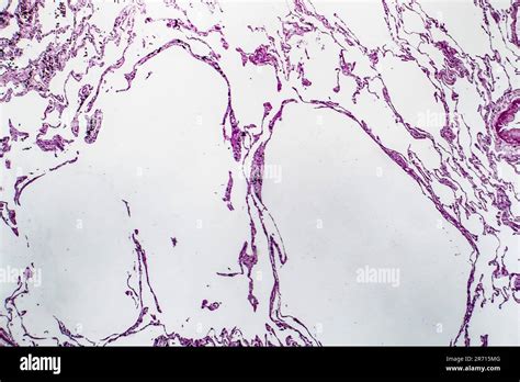 Histopathology Of Lung Emphysema Light Micrograph Photo Under