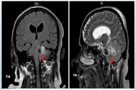 Mri Showing Left Posterior Fossa And Cerebellpontine Angle Lesion