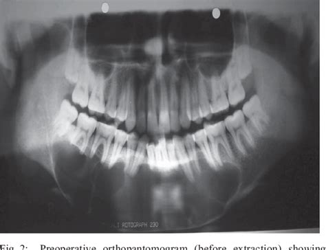 Figure From Conservative Management Of Keratocystic Odontogenic