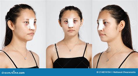 Asian Face Reconstructive Surgery Telegraph