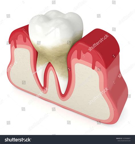 3d Render Tooth Bleeding Gums Over 스톡 일러스트 1529588807 | Shutterstock
