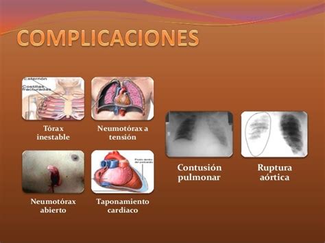 Traumatismo Toracico Y Sus Complicaciones