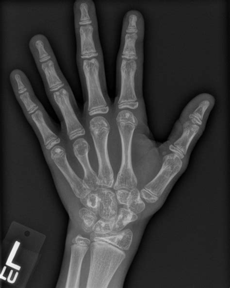 Osteopoikilosis Pediatric Hand Radiology Case Radshare Net