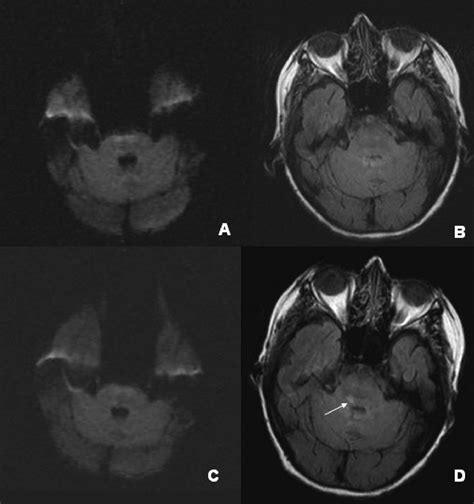 When To Expect Negative Diffusion Weighted Images In Stroke And