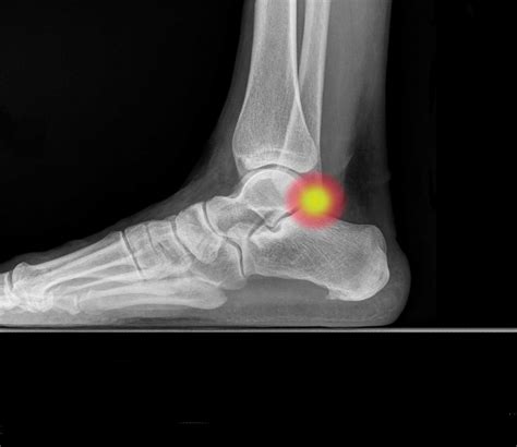 Os-trigonum | Idea Ortopedia