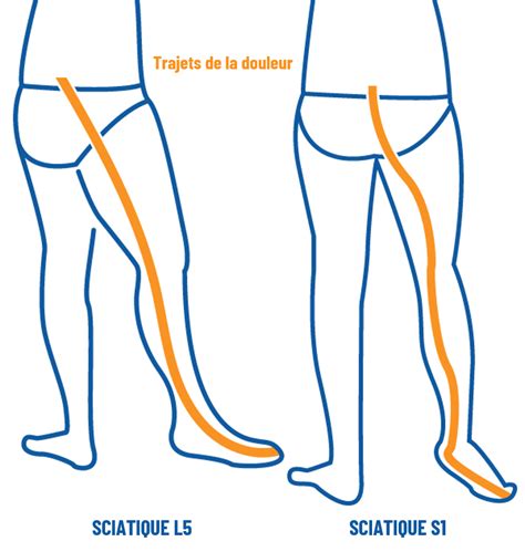 Soulager La Sciatique Sciatalgie Ou Lombosciatique Artofit