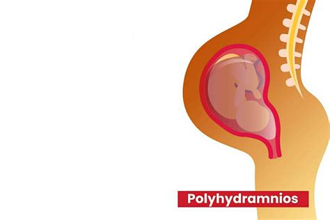 Polyhydramnios Excessive Amniotic Fluid During Pregnancy Being The