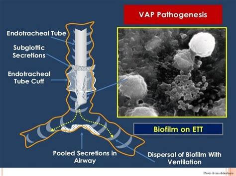 Ventilator Associated Pneumonia Vap Or Hospital Acquired Pneumonia