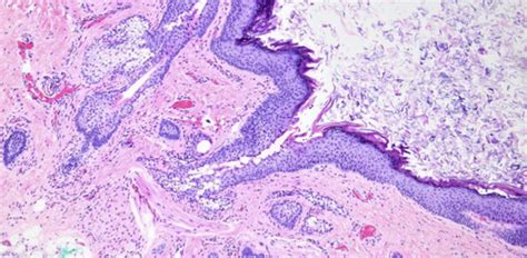 Neoplastic And Reactive Diseases Of The Skin Flashcards Quizlet