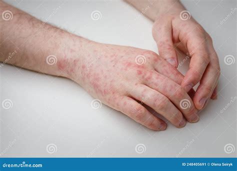 Allergy Red Itchy Rash On Male Hands On White Table Dermatological Problem Skin Symptom Of