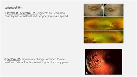 Retinal dystrophy | PPT