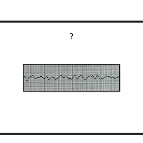 Ekg Final Exam Flashcards Quizlet