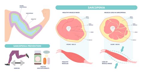 Sarcopenia: Symptoms, Causes, Risk Factors & Treatment