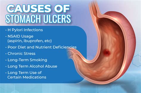 STOMACH ULCER- CAUSES, SYMPTOMS AND TREATMENT - Forever Champion Health ...