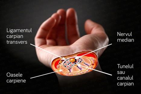 SINDROMUL DE TUNEL CARPIAN NEUROBRAIN CLINIQ Clinică neurologie