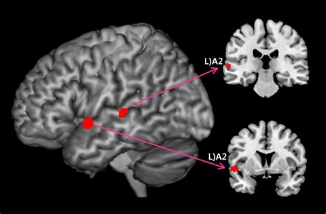 Auditory Cortex Mri