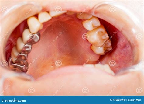 Metal Basis Dental Bridge Stock Photo Image Of Enamel 136029198