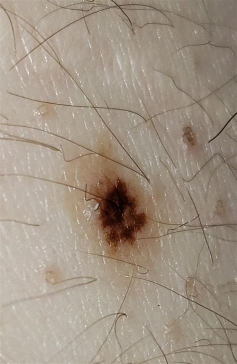 Possible Melanoma? : r/Melanoma