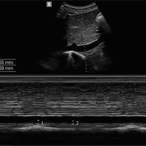 Inferior Vena Cava Diameter Assessment At Expiration D1 And At