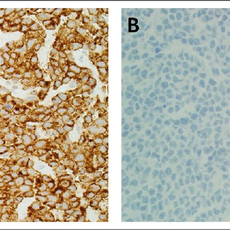 A The Tumor Cells Are Diffusely And Strongly Positive For Cd By