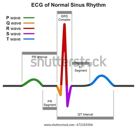 EKG Normale Sinus Rhythmus Infografik Mit Normaler Herzschlag Welle