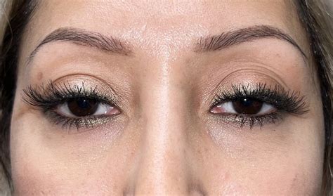 5 Eyelid Filler Before And After Photos Dallas Plano Texas Cosmetic Reconstructive Eye Surgery