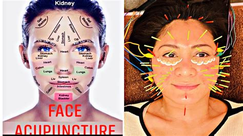 Acupuncture Facial Treatment The Best Facial Treatment Ever No Need Injections Or Surgery Youtube