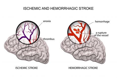 Pediatric Stroke Malpractice - Ohio Stroke Lawyer