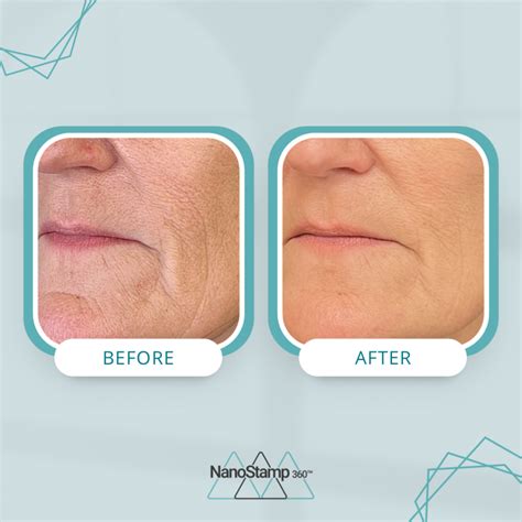 Non Surgical Skin Tightening Micro Channeling In Orlando FL Real